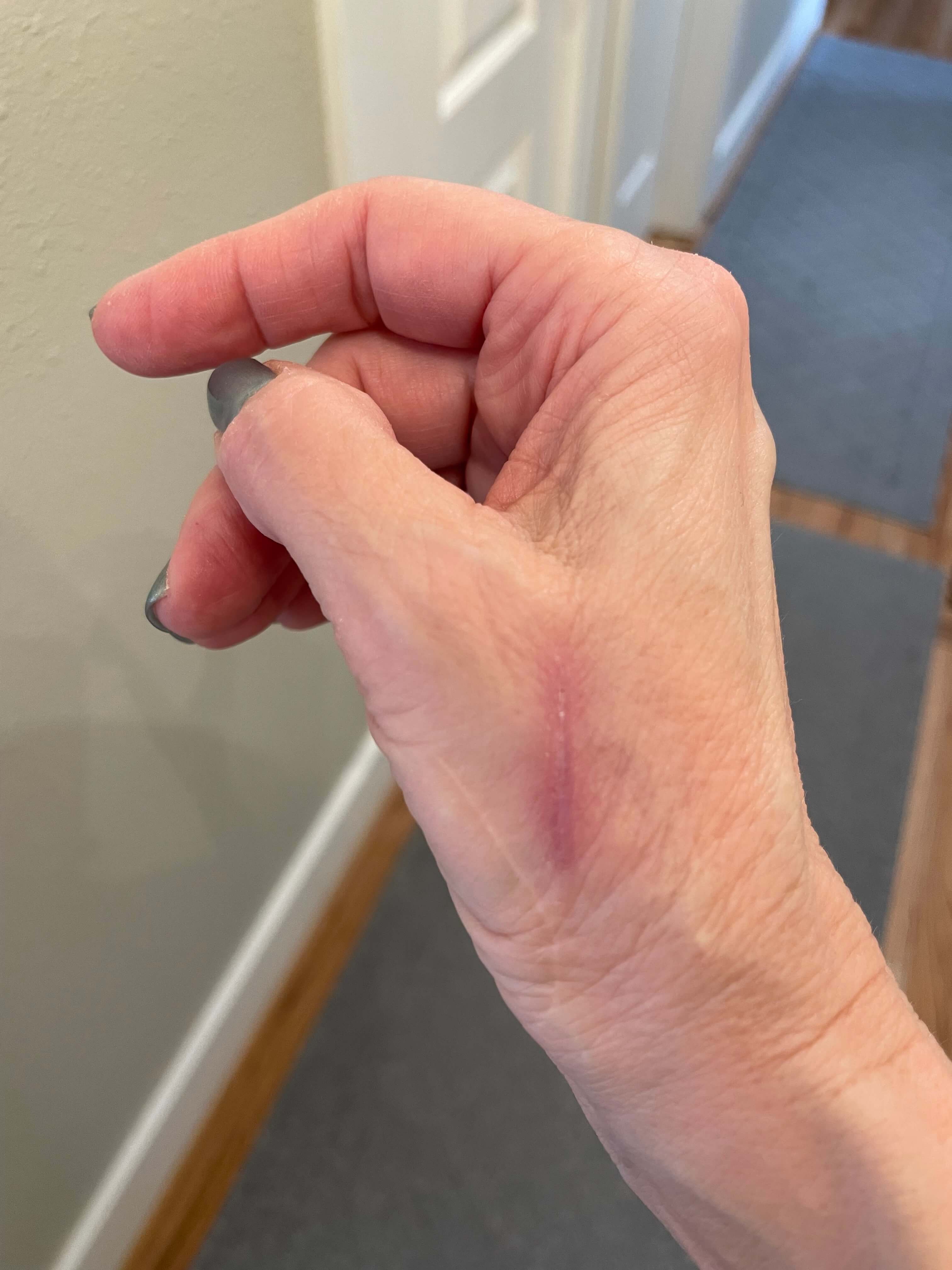 burned hand with scar using bedrock balm