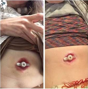 stoma feeding tube before and after bedrock Stoma barrier cream