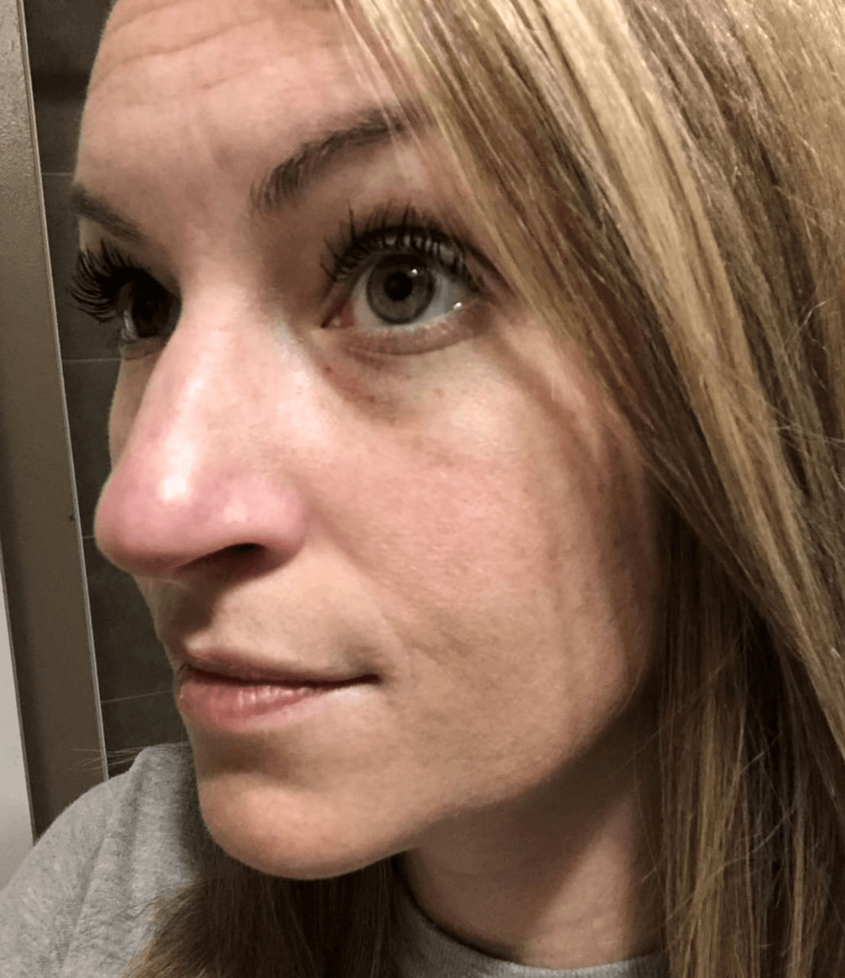 Acne pictures before and after porefector