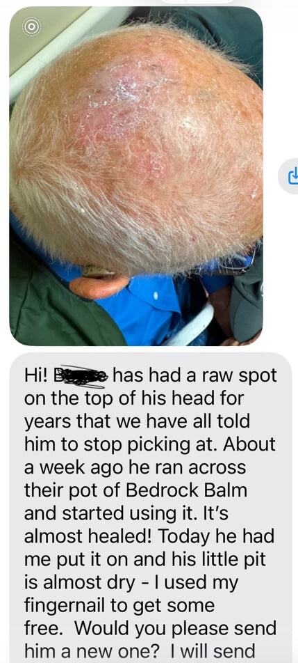 how to get rid of red patches on top of head - Bedrock Balm