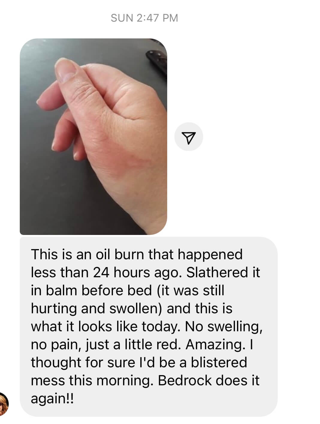 What to Put on Oil Burn From Cooking - Bedrock Balm