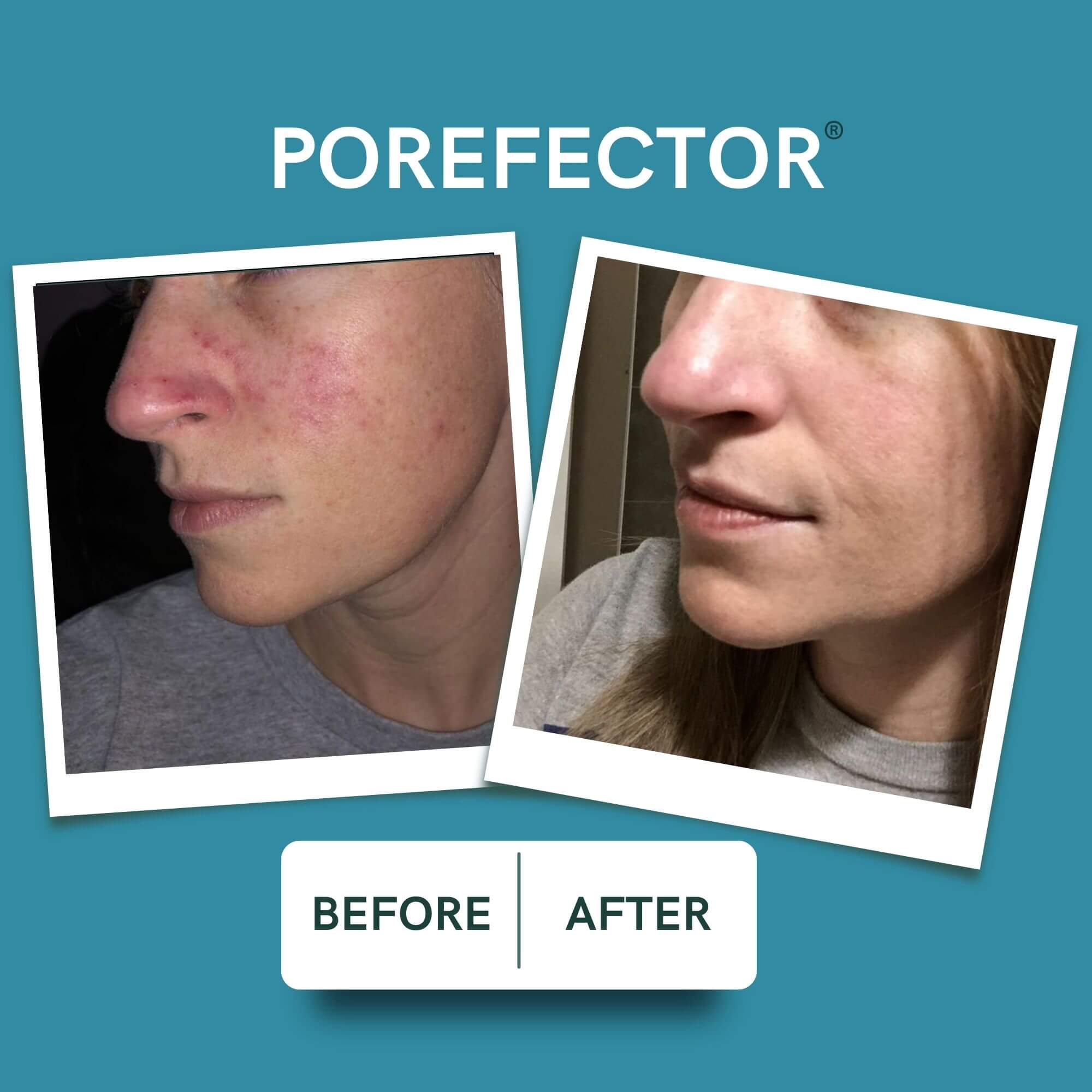 Porefector | Blemish Cream + Blackhead Mask