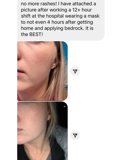 Anti redness cream before and after