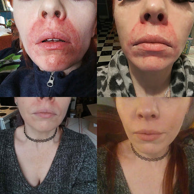 How to Help Perioral Dermatitis | Before & After Pictures with Bedrock Balm