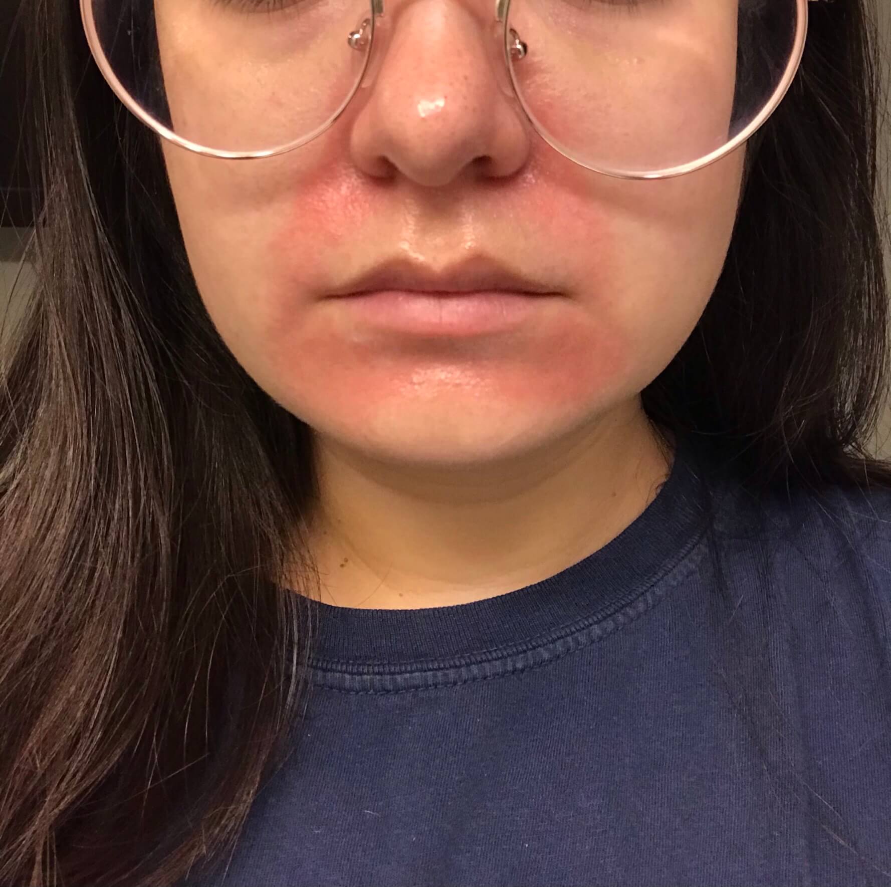 Zinc Cream Perioral Dermatitis - Bedrock Balm