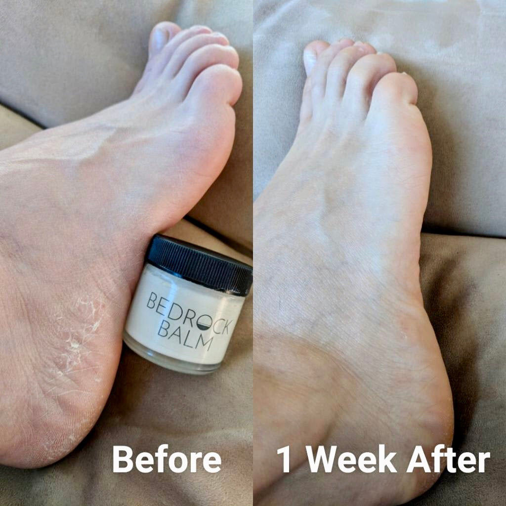 before and after of dry cracked heel using bedrock balm