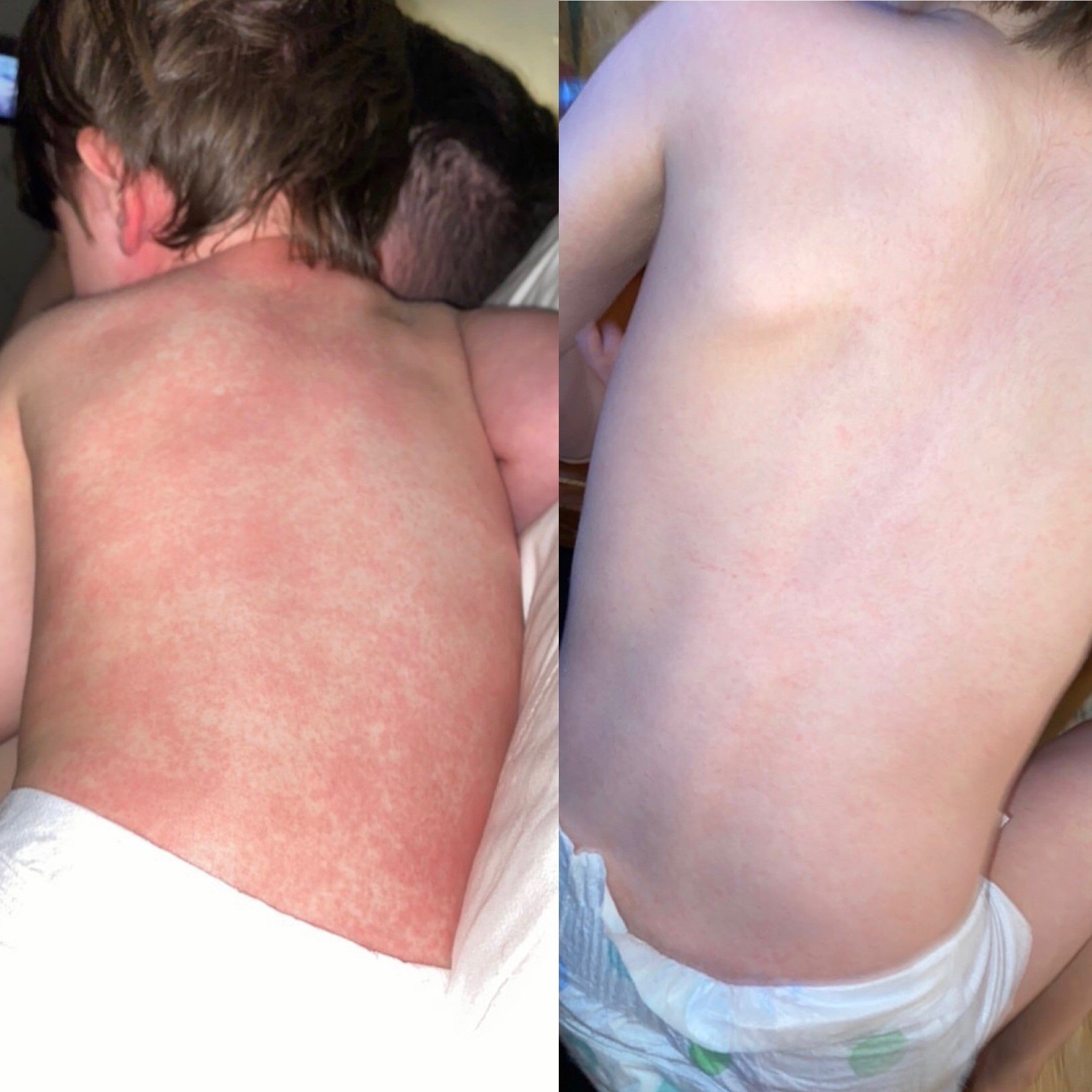 little boy before and after using Bedrock cream for red spots