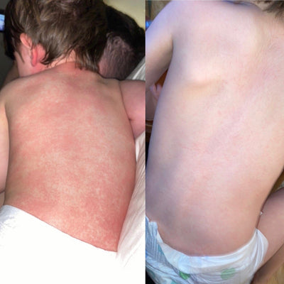 Megan’s Story: Calming Her Toddler’s Red Spots with Bedrock Balm