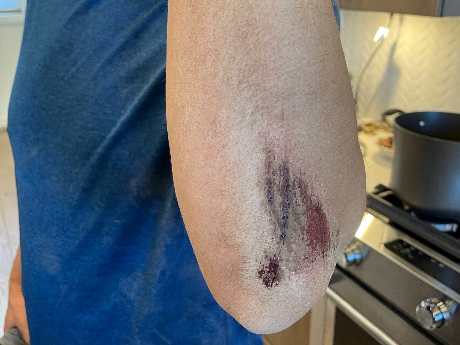 scrape on arm